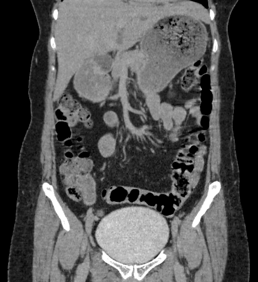 Autosomal dominant polycystic kidney disease (Radiopaedia 38189-40194 Coronal C+ delayed 26).jpg