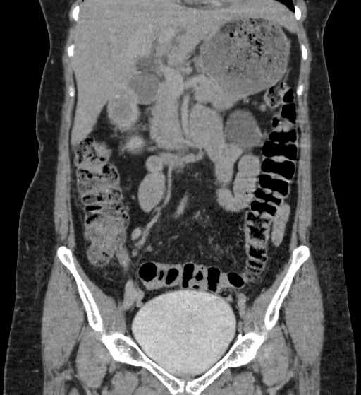 Autosomal dominant polycystic kidney disease (Radiopaedia 38189-40194 Coronal C+ delayed 31).jpg