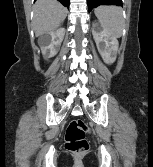 Autosomal dominant polycystic kidney disease (Radiopaedia 38189-40194 Coronal C+ delayed 82).jpg