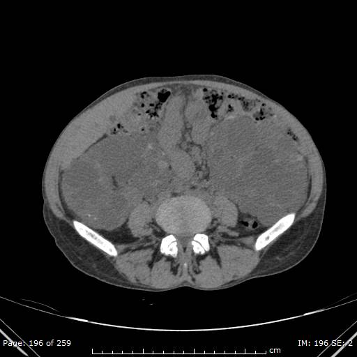 Autosomal dominant polycystic kidney disease (Radiopaedia 44122-47684 Axial non-contrast 70).jpg