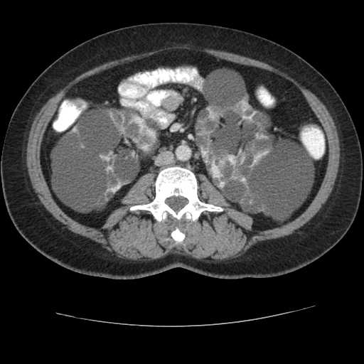 Autosomal dominant polycystic kidney disease with hepatic involvement (Radiopaedia 32693-33662 B 42).jpg