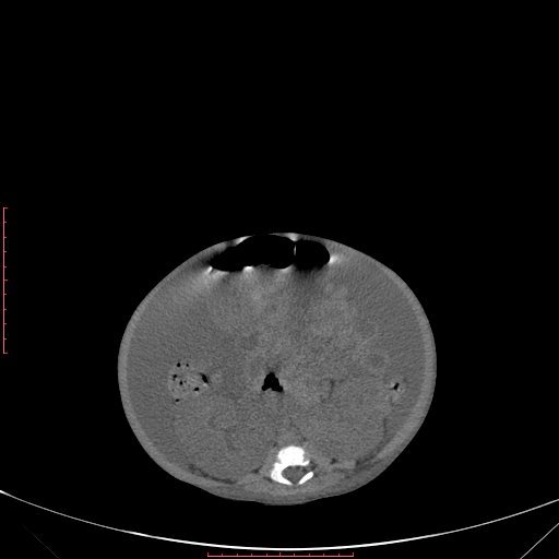 Autosomal recessive polycystic kidney disease associated with Caroli disease (Radiopaedia 61932-69984 Axial non-contrast 239).jpg