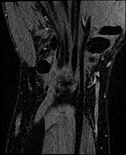 Avascular necrosis of the capitate (Radiopaedia 88317-104948 Coronal T1 vibe 62).jpg