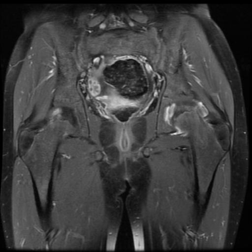 File:Avascular necrosis of the hip (Radiopaedia 29563-30067 I 10).jpg