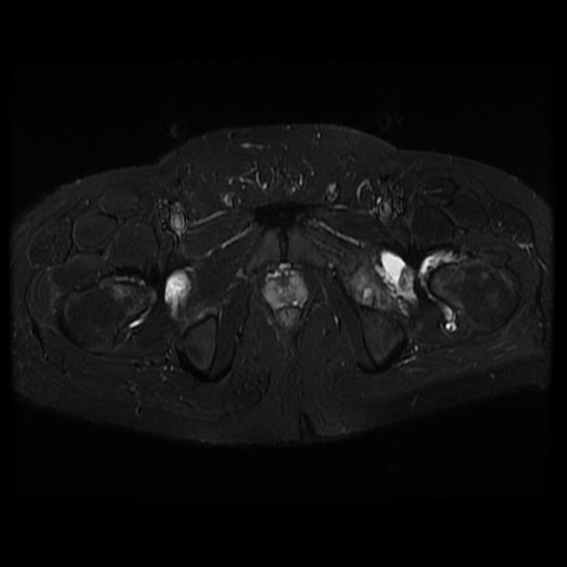 File:Avascular necrosis of the hip (Radiopaedia 61503-69465 Axial STIR 22).jpg