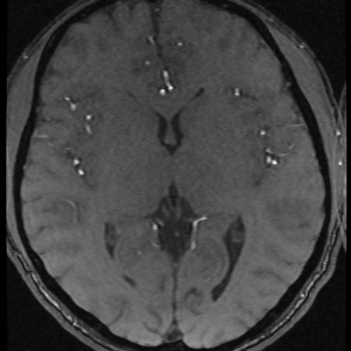 Azygos anterior cerebral artery (Radiopaedia 17059-16756 Axial MRA 13).jpg