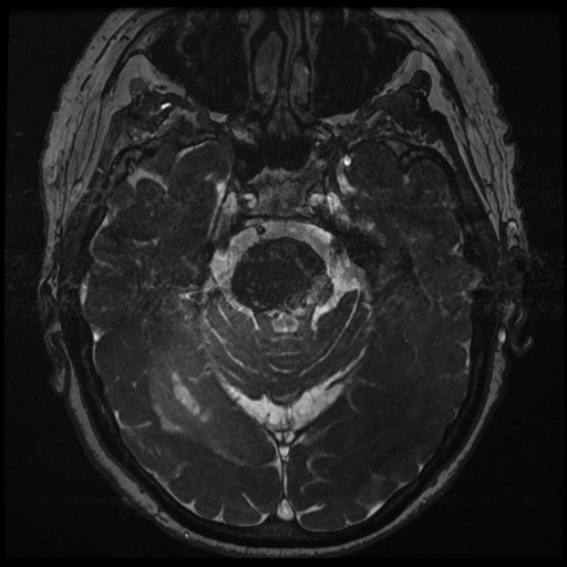 File:Balo concentric sclerosis (Radiopaedia 53875-59982 Axial T2 FIESTA 59).jpg