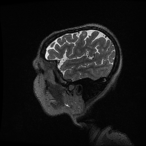 Balo concentric sclerosis (Radiopaedia 53875-59982 Sagittal 3D FSE 37).jpg
