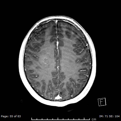 Balo concentric sclerosis (Radiopaedia 61637-69636 Axial T1 C+ 55).jpg
