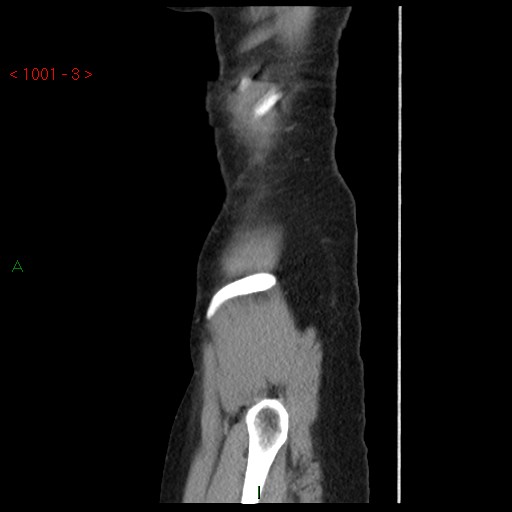 File:Bartholin gland cyst (Radiopaedia 54904-61181 Sagittal C+ delayed 3).jpg