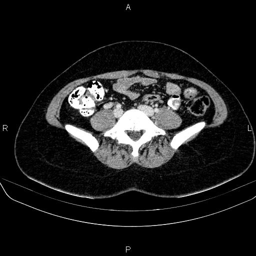 File:Bartholin gland cyst (Radiopaedia 62635-70930 Axial Post contrast 5).jpg