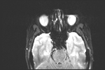 File:Basal cell carcinoma - nasal region (Radiopaedia 70292-80365 Axial DWI 6).jpg