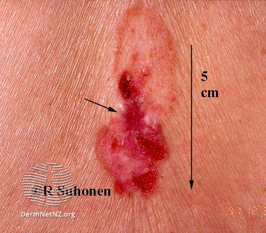 File:Basal cell carcinoma affecting the trunk (DermNet NZ lesions-bcc-trunk-0643).jpg