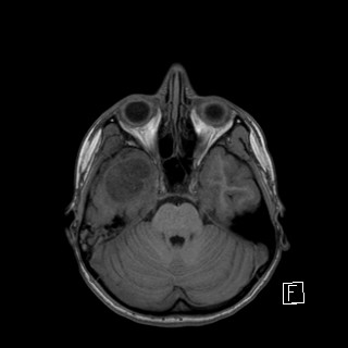 File:Base of skull rhabdomyosarcoma (Radiopaedia 32196-33142 Axial T1 15).jpg