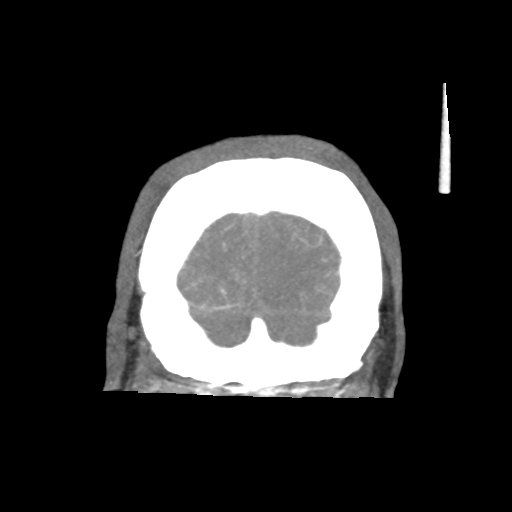 Basilar and bilateral vertebral artery occlusion (Radiopaedia 45592-49723 B 89).png