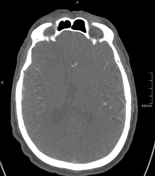 File:Basilar artery aneurysm (Radiopaedia 56261-62932 A 87).jpg