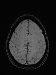 Basilar artery perforator aneurysm (Radiopaedia 82455-97733 Axial SWI 48).jpg
