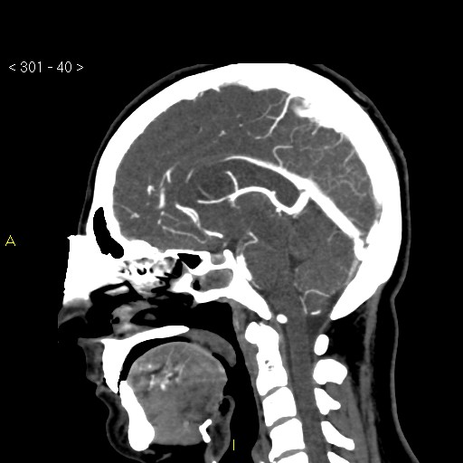 Basilar artery thrombosis (Radiopaedia 16260-15944 C 34).jpg