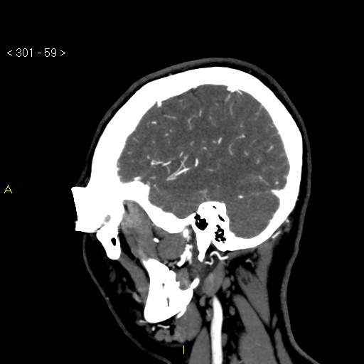 Basilar artery thrombosis (Radiopaedia 16260-15944 C 53).jpg