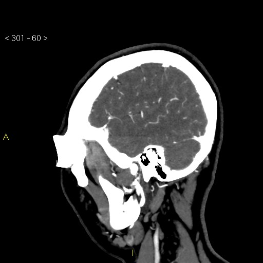 File:Basilar artery thrombosis (Radiopaedia 16260-15944 C 54).jpg