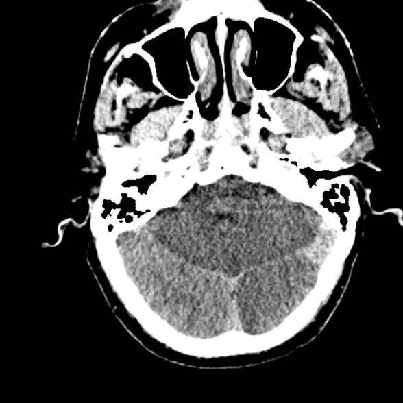 Basilar artery thrombosis (Radiopaedia 53351-59352 Axial non-contrast 35).jpg