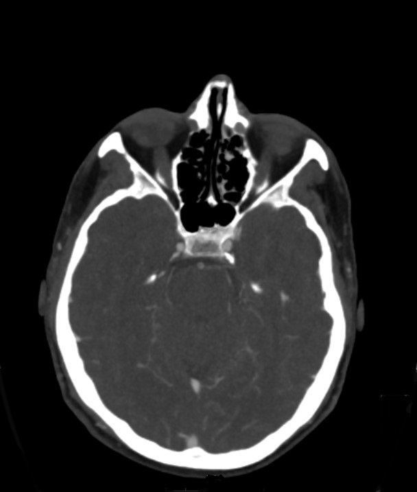Basilar artery thrombosis and ascending transtentorial herniation (Radiopaedia 84759-100360 B 39).jpg