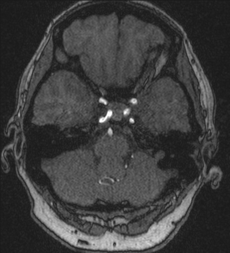 File:Basilar tip aneurysm (Radiopaedia 26504-26632 MRA 49).jpg