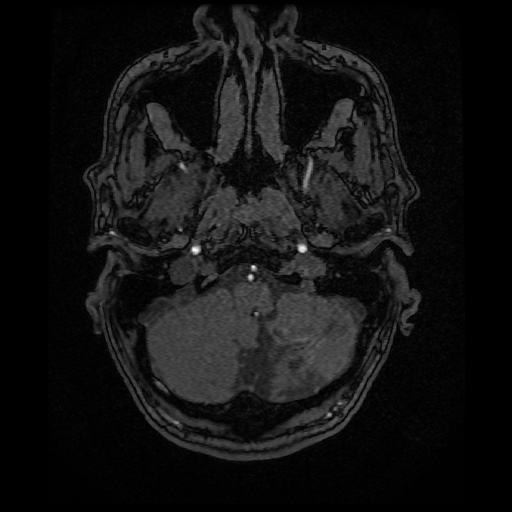 Basilar top and left middle cerebral artery aneurysm (Radiopaedia 61965-70031 Axial MRA 11).jpg