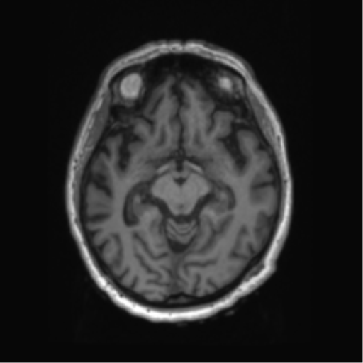 Behavioral variant frontotemporal dementia and late onset schizophrenia (Radiopaedia 52197-58083 Axial T1 62).png