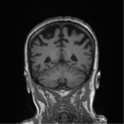 File:Behavioral variant frontotemporal dementia and late onset schizophrenia (Radiopaedia 52197-58083 Coronal T1 32).png