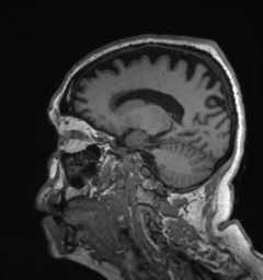 Behavioral variant frontotemporal dementia and late onset schizophrenia (Radiopaedia 52197-58083 Sagittal T1 65).png