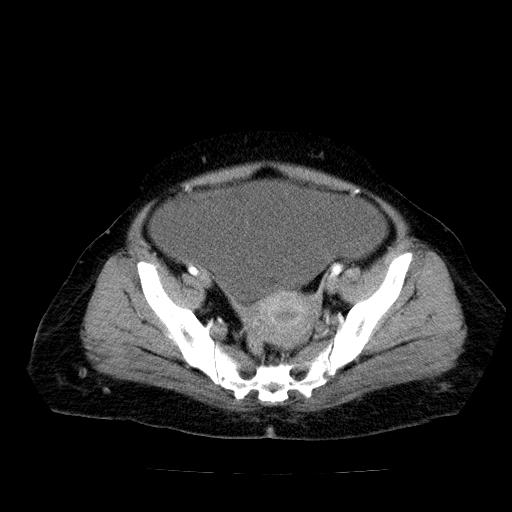Benign spindle cell tumor - abdominopelvic (Radiopaedia 61300-69212 A 50).jpg