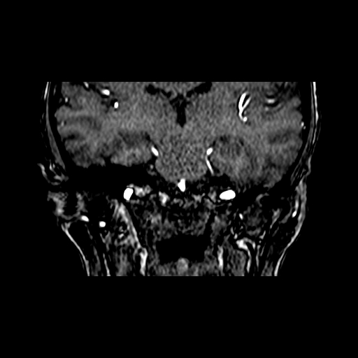 File:Berry aneurysm of the terminal internal carotid artery (Radiopaedia 88286-104918 Coronal TOF 56).jpg