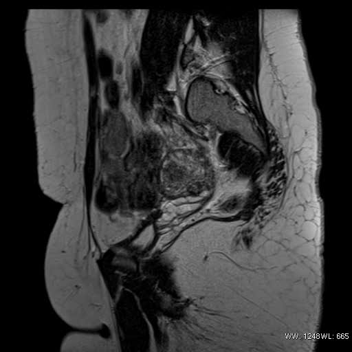 File:Bicornuate uterus- on MRI (Radiopaedia 49206-54297 Sagittal T2 7).jpg