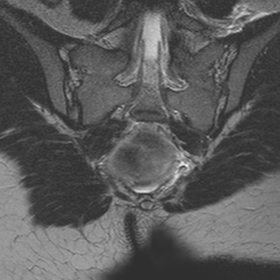 File:Bicornuate uterus (Radiopaedia 24677-24949 Coronal T2 23).jpg