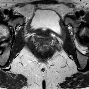 File:Bicornuate uterus (Radiopaedia 61974-70046 Axial T2 24).jpg