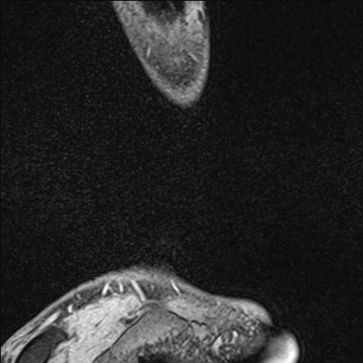 Bilateral Achilles tendon complete tear (Radiopaedia 81344-95051 Sagittal WE - Left 18).jpg