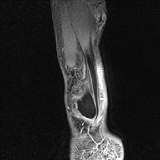 Bilateral Achilles tendon complete tear (Radiopaedia 81344-95051 Sagittal WE - Right 16).jpg