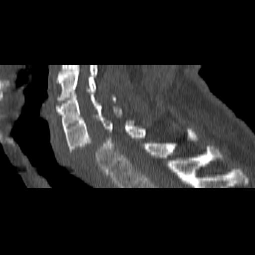 File:Bilateral C6-7 locked facet dislocation (Radiopaedia 28506-28748 Sagittal bone window 12).jpeg