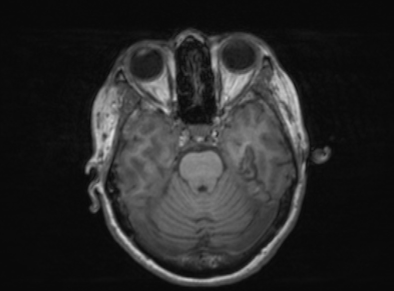 Bilateral PCA territory infarction - different ages (Radiopaedia 46200-51784 Axial T1 284).jpg