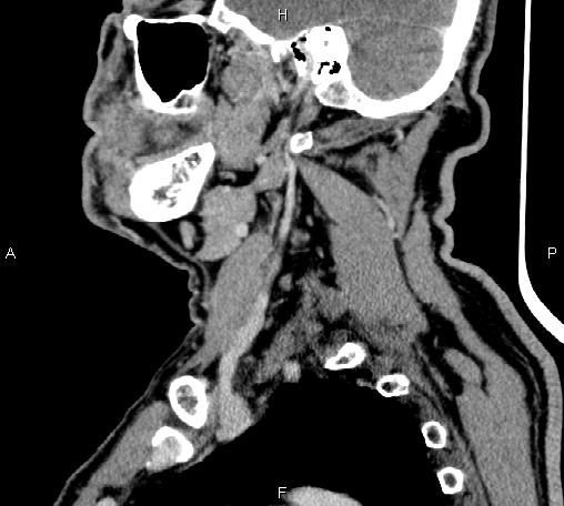 Bilateral Warthin tumors (Radiopaedia 84034-99263 D 54).jpg