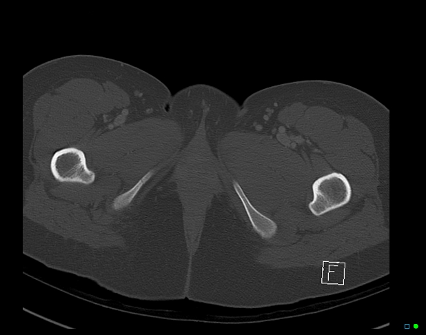 Bilateral acetabular fractures (Radiopaedia 79272-92308 Axial bone window 65).jpg
