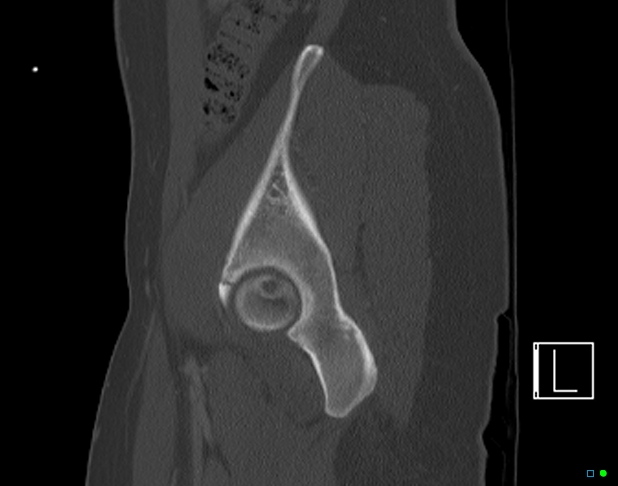 File:Bilateral acetabular fractures (Radiopaedia 79272-92308 Sagittal bone window 21).jpg