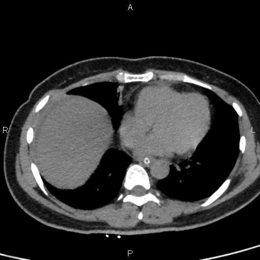 File:Bilateral adrenal gland hyperenhancement in pancreatitis (Radiopaedia 86642-102753 Axial non-contrast 4).jpg