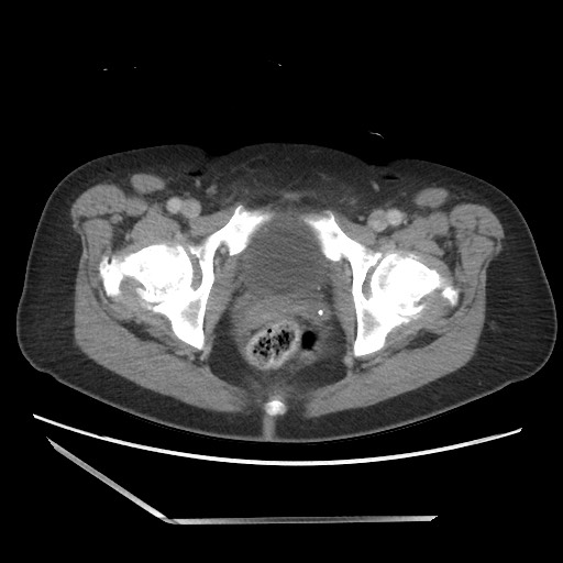 File:Bilateral adrenal granulocytic sarcomas (chloromas) (Radiopaedia 78375-91007 A 116).jpg