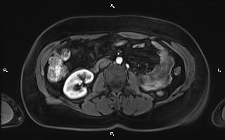 Bilateral adrenal myelolipoma (Radiopaedia 63058-71537 Axial T1 C+ fat sat 57).jpg