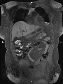 Bilateral adrenal myelolipoma (Radiopaedia 63058-71537 Coronal T1 fat sat 80).jpg