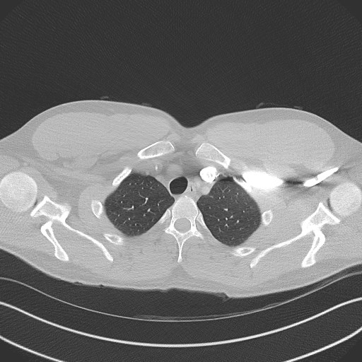 File:Bilateral atelectasis (Radiopaedia 48666-53675 Axial lung window 12).jpg