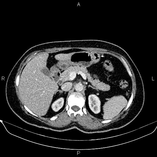 Bilateral benign adrenal adenomas (Radiopaedia 86912-103124 B 35).jpg