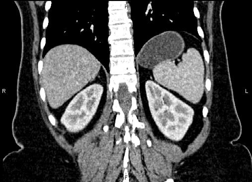 Bilateral benign adrenal adenomas (Radiopaedia 86912-103124 D 49).jpg